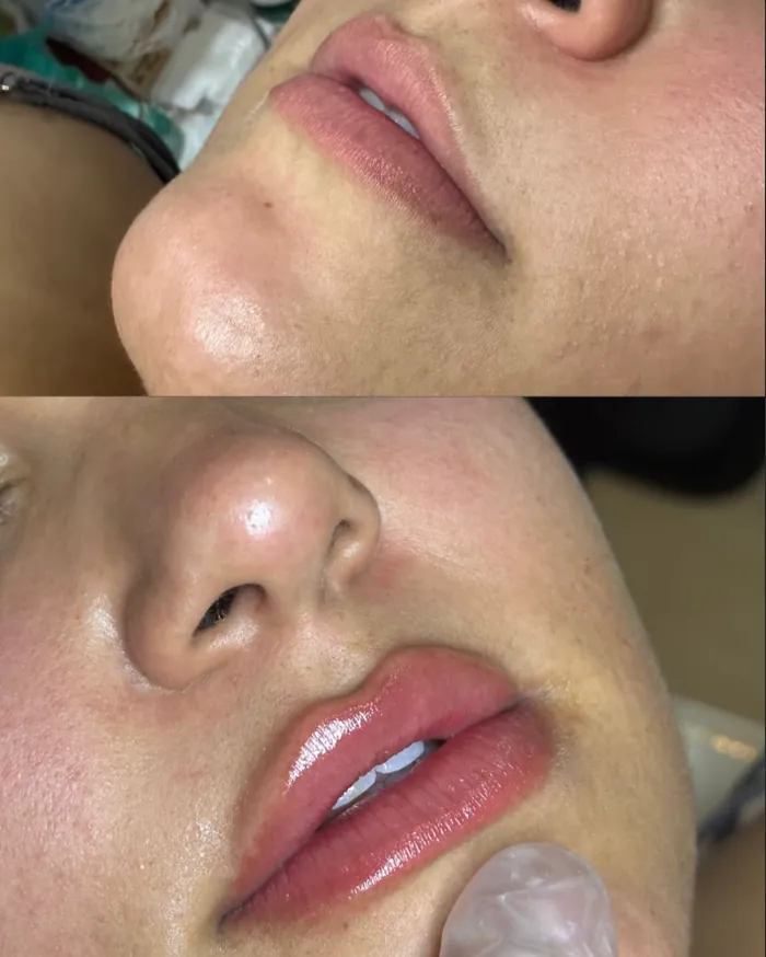 Antes e depois de preenchimento labial