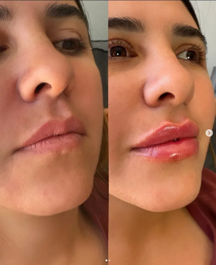 Antes e depois de preenchimento labial