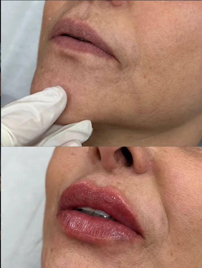 Antes e depois de preenchimento labial